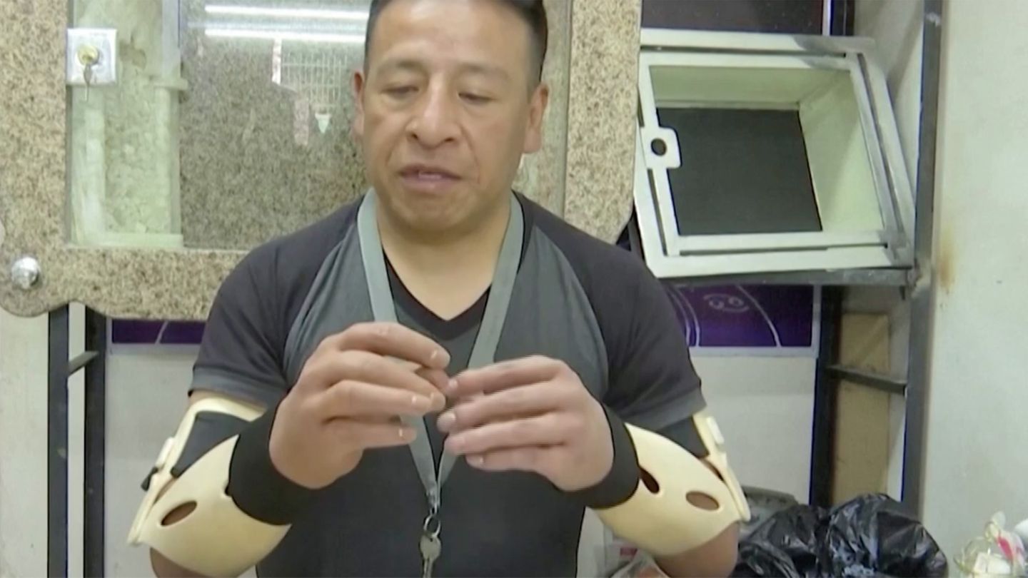 Opfer von Dynamitexplosion: "Als ich aufwachte, waren meine Hände weg" – Hersteller hilft mit hyperrealistischer Prothese