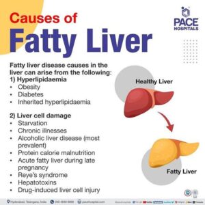 Alarming Surge in Fatty Liver Disease Among Young Adults in India: What You Need to Know