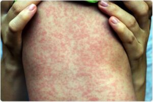 Unraveling the Mystery: What’s Fueling Australia’s Record-High Measles Outbreak?