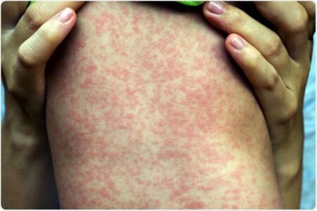 Unraveling the Mystery: What’s Fueling Australia’s Record-High Measles Outbreak?