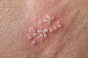 Breaking the Silence: Why Genital Herpes Remains Under-Reported Due to Shame and Stigma