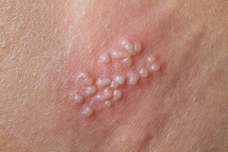 Breaking the Silence: Why Genital Herpes Remains Under-Reported Due to Shame and Stigma