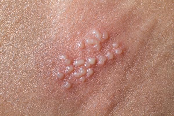 Breaking the Silence: Why Genital Herpes Remains Under-Reported Due to Shame and Stigma