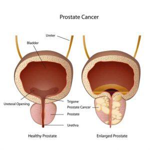 Breaking News: Former President Biden Faces Battle with Aggressive Prostate Cancer
