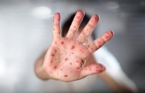 Canada’s Measles Outbreak Surges Beyond U.S. Case Numbers