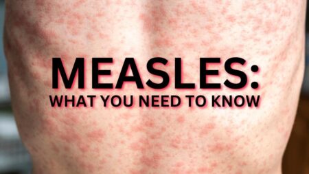 Measles Outbreak Intensifies in Rural Alberta Amid Vaccine Hesitancy