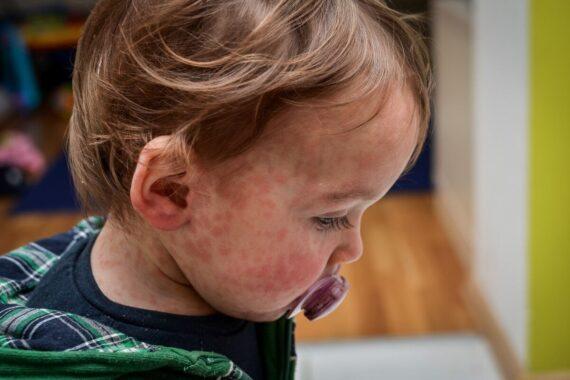 Measles Outbreak Explodes Across the Americas This Year, Canada Faces Biggest Impact with 71% Unvaccinated