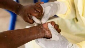 Officials Confirm First Known Cases of Severe Mpox Strain Spreading Across the US