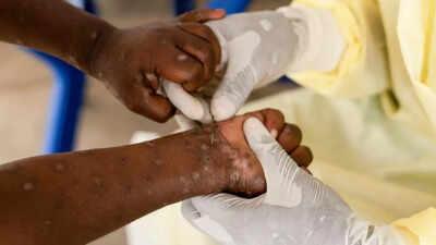 Officials Confirm First Known Cases of Severe Mpox Strain Spreading Across the US
